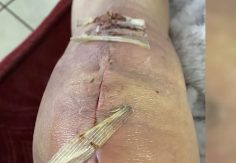 Mujer hispana denuncia negligencia médica tras cirugías fallidas en Las Vegas